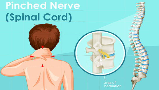 Chiropractic for pinched nerve pain relief in Louisville