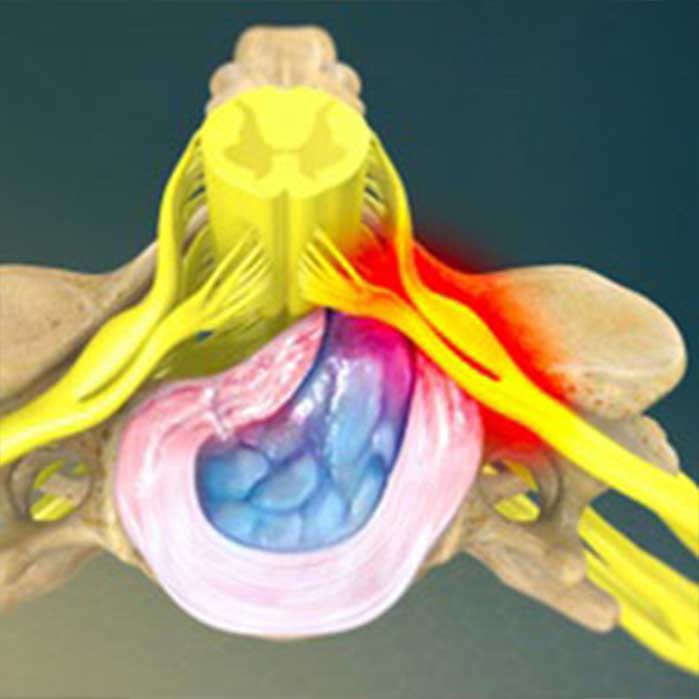 Chiropractic for herniated disc in Louisville